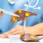 gallbladder stone symptoms