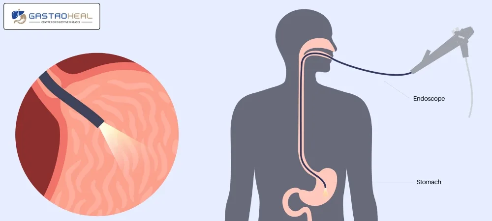 endoscopy test