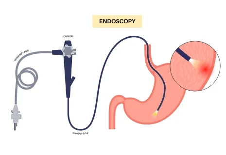 is endoscopy painful