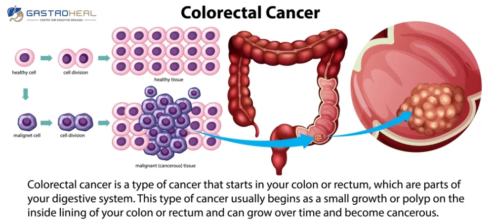 colon cancer symptoms