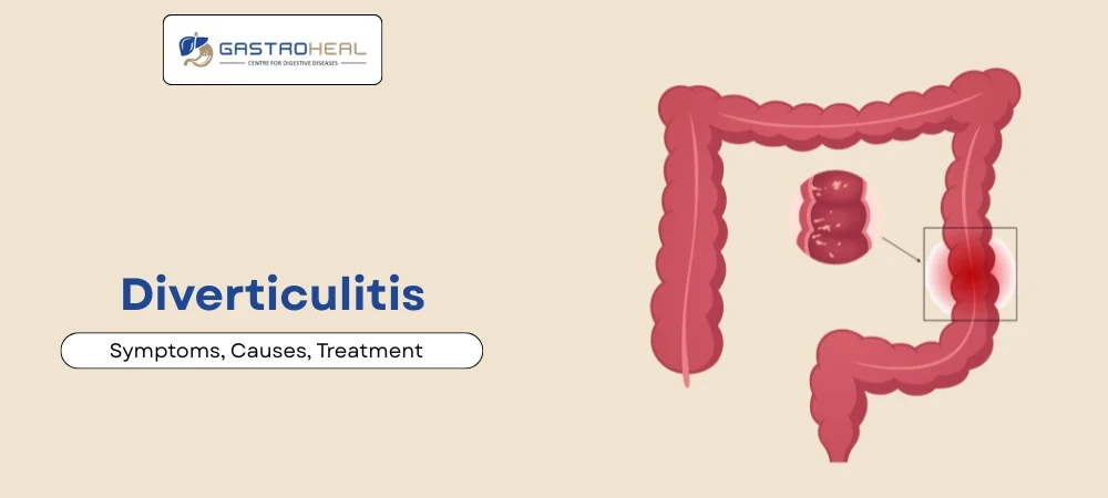 diverticulitis treatment