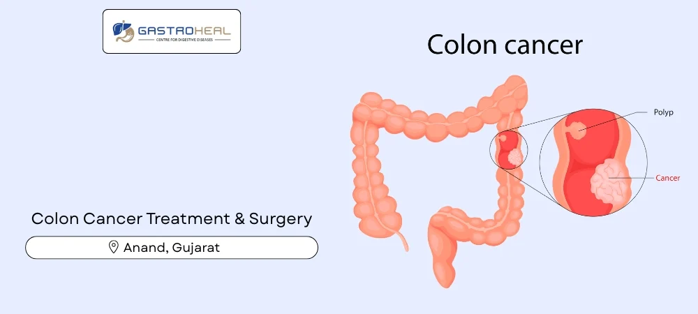 rectal cancer signs